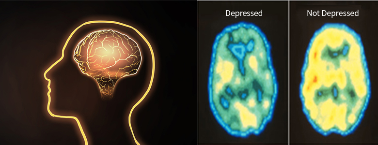 뇌 촬영 영상물 - 우울할때  depressed 상태일때 푸른색 영역이 많아지고  Not depressed  상태일때 노란색 영역이 많고 푸른색 영역이 작아진다.
